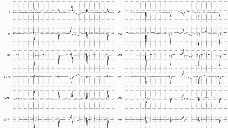 Interpolated VEBS 12 Lead EKG